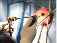 Innovation en chirurgie vaginale - La technique chirurgicale Vnotes pratiquée à la Clinique de Vitrolles.